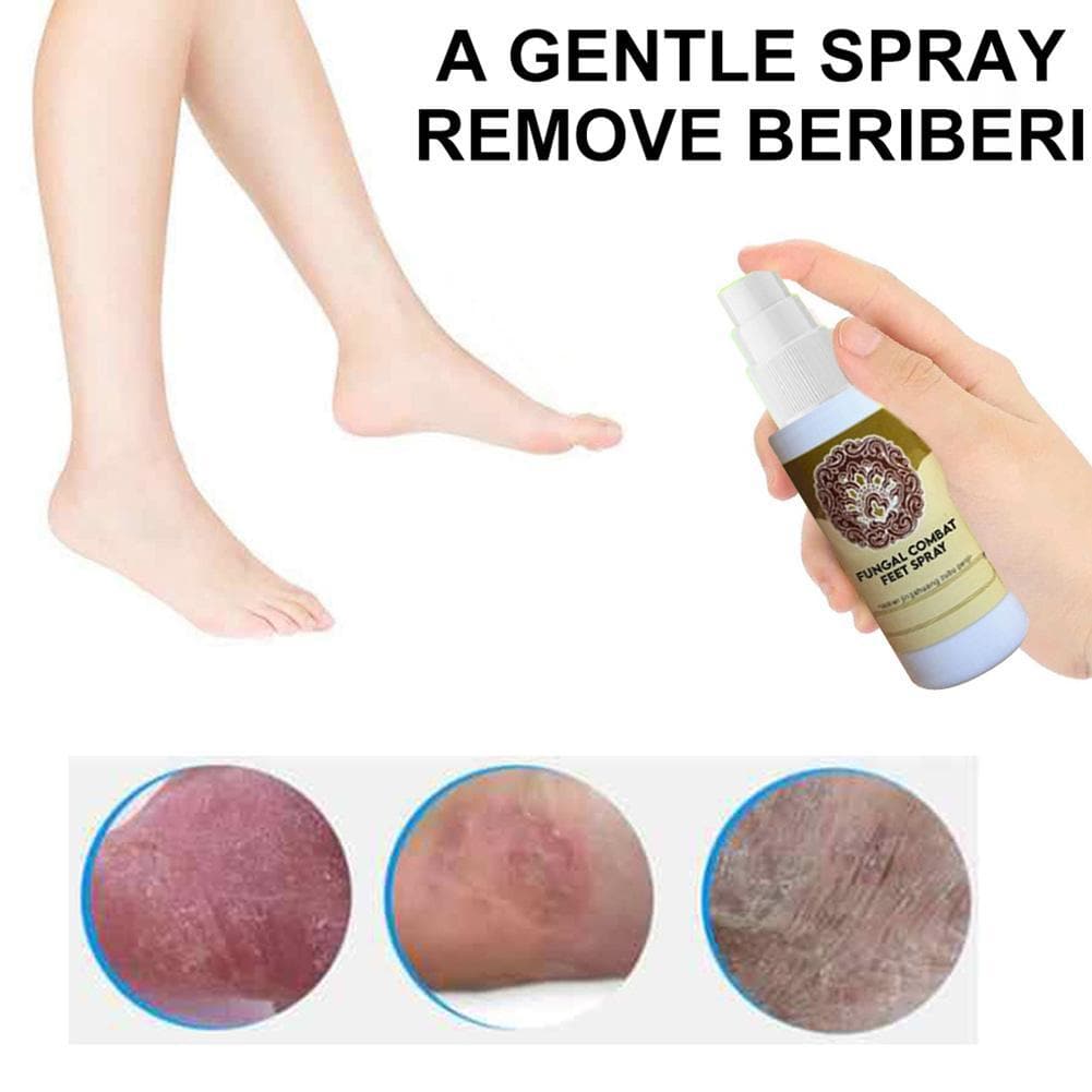 Fungal Treatment Foot Spray - Beauty And Personal Care - DYAVOR®