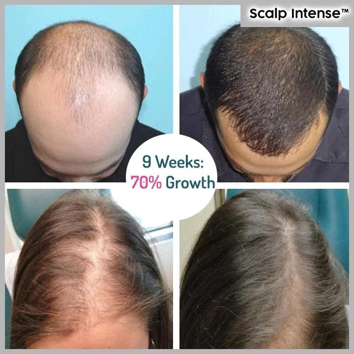 Scalp Intense™ - Hair Growth Serum - Personal Care - DYAVOR®