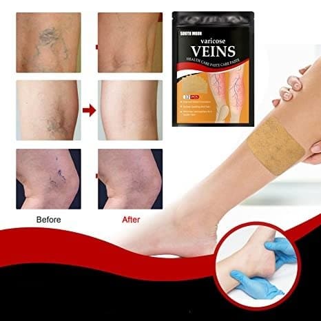 Varicose Veins Treatment Patch - Skin Care Masks & Peels - DYAVOR®
