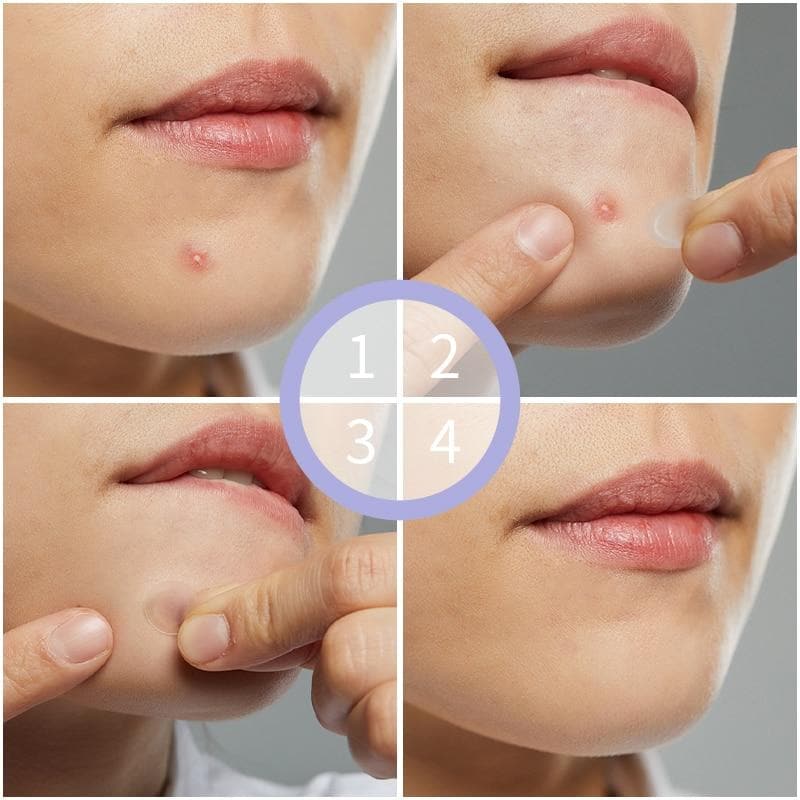 Wild+ Invisible Acne Patch - - Beauty And Personal Care - DYAVOR®