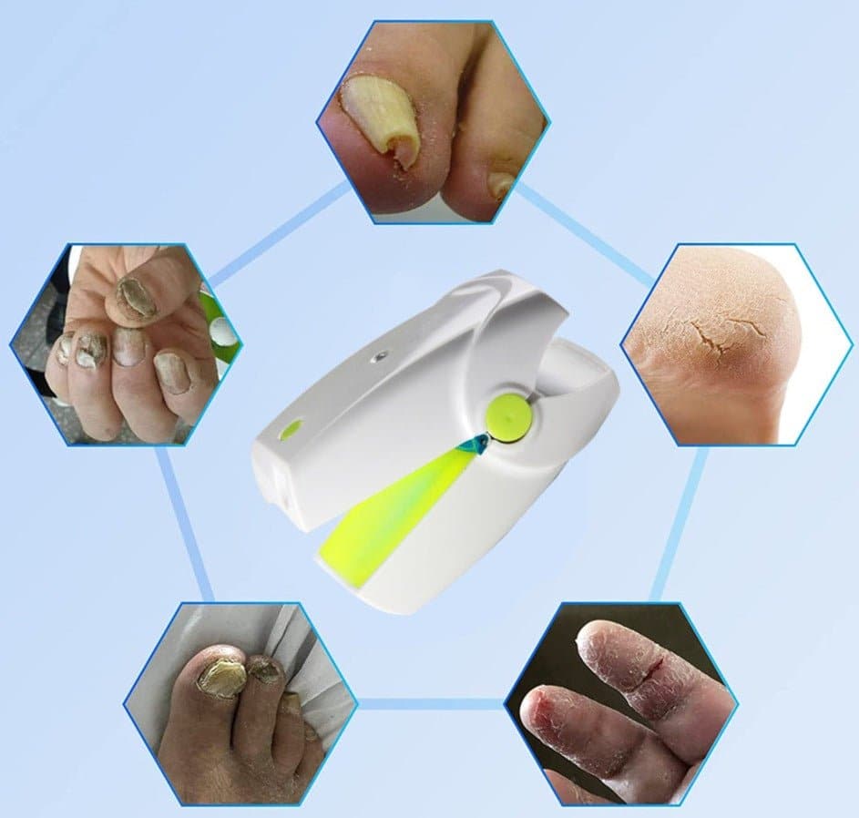  Portable Fungus Nail Laser - Nail Care - DYAVOR® 