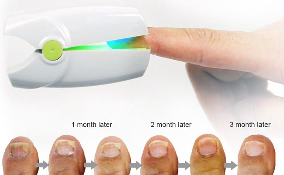  Portable Fungus Nail Laser - Nail Care - DYAVOR® 