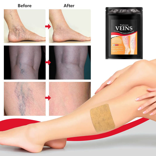  Varicose Veins Treatment Patch - Skin Care Masks & Peels - DYAVOR® 
